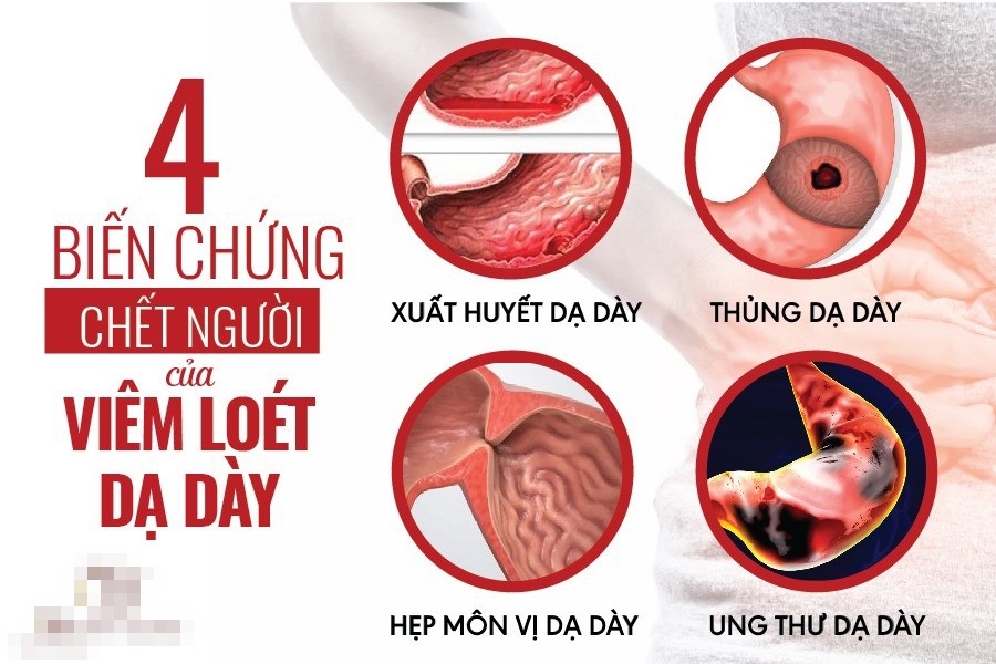 Biến chứng nguy hiểm của bệnh dạ dày